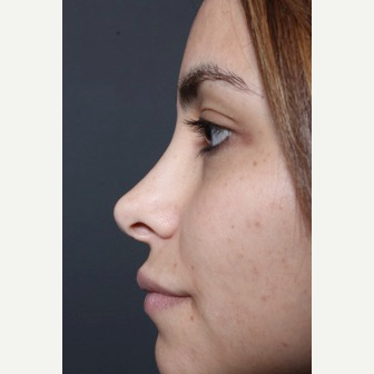 25-34 year old woman treated with Non Surgical Nose Job before 3590825