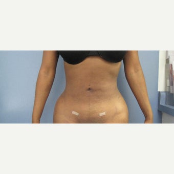 25-34 year old woman treated with Fat Transfer after 1684716