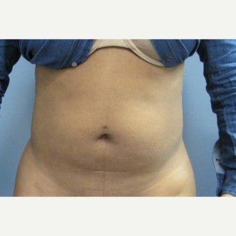 25-34 year old woman treated with Fat Transfer before 1684716