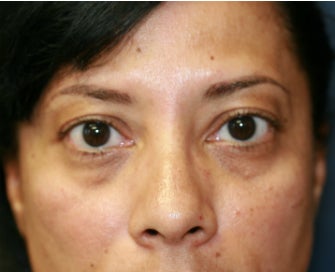 Radiesse to fill lower eyelid hollows before 845634