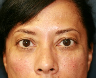 Radiesse to fill lower eyelid hollows after 845634