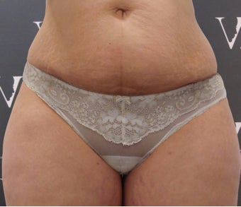 Coolsculpting helped to get the pre-pregnancy figure back after 3265201