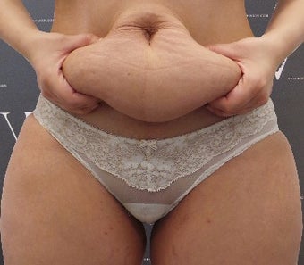 Coolsculpting helped to get the pre-pregnancy figure back before 3265201