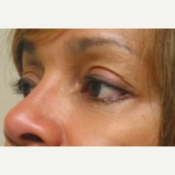 Lower lid blepharoplasty with lateral canthopexy and 2 syringes Perlane to cheeks in 46 year old 1938314
