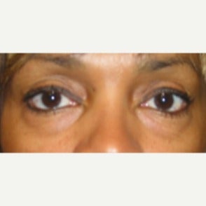Lower lid blepharoplasty with lateral canthopexy and 2 syringes Perlane to cheeks in 46 year old before 1938314