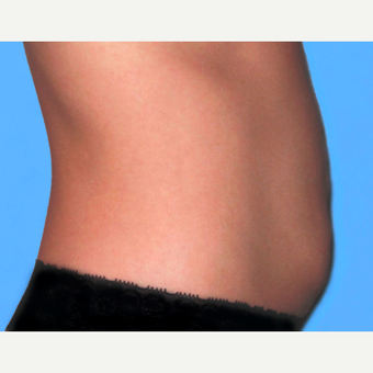 Tummy Tuck before 3810788
