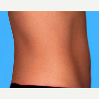 Tummy Tuck after 3810788