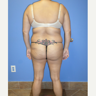 35-44 year old woman treated with Weight Loss before 3370145