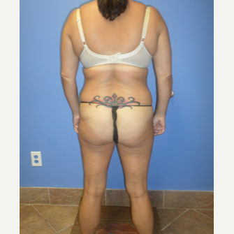 35-44 year old woman treated with Weight Loss after 3370145