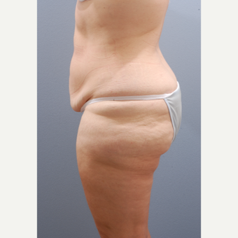 45-54 year old woman treated with Tummy Tuck before 3603920