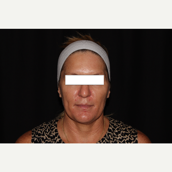35-44 year old woman treated with Silhouette InstaLift before 3569562