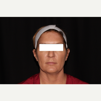 35-44 year old woman treated with Silhouette InstaLift after 3569562
