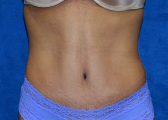 Poorly done "Mini-tummy tuck" after 1392926