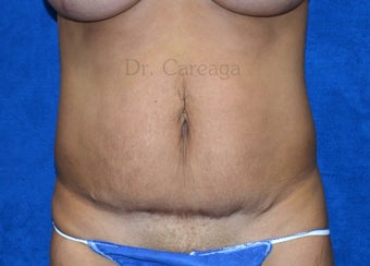 Poorly done "Mini-tummy tuck" before 1392926