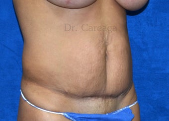 Poorly done "Mini-tummy tuck" 1392926