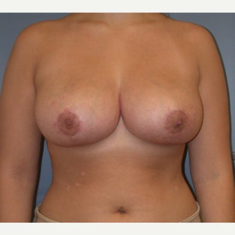 18-24 year old woman treated with Breast Reduction after 1537344