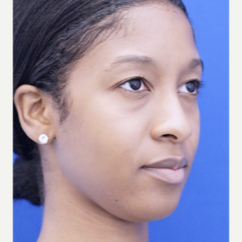 25-34 year old woman treated with Rhinoplasty before 3703401