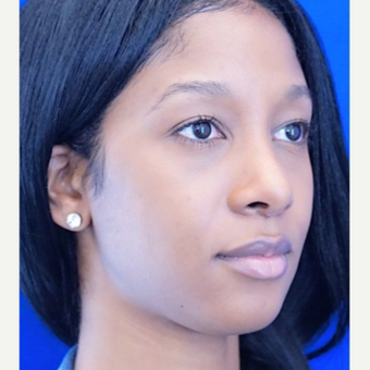 25-34 year old woman treated with Rhinoplasty after 3703401