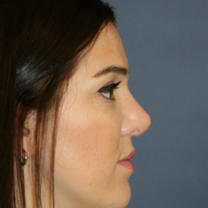 25-34 year old woman treated with Rhinoplasty after 3559830