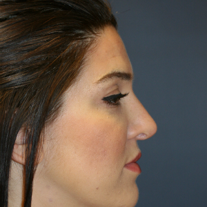 25-34 year old woman treated with Rhinoplasty before 3559830