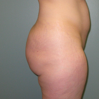 36 year old woman treated with Butt Augmentation 1866229
