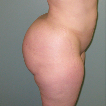 36 year old woman treated with Butt Augmentation 1866229