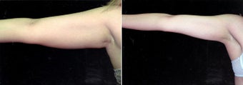 34-year-old woman treated with Liposuction. before 3287536