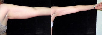 34-year-old woman treated with Liposuction. after 3287536
