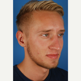 22 year old gentleman treated with Rhinoplasty before 3576753
