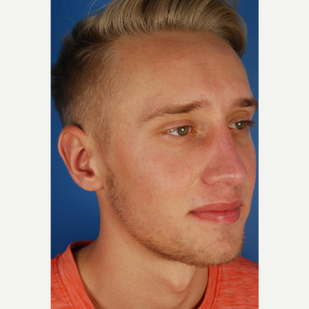 22 year old gentleman treated with Rhinoplasty after 3576753