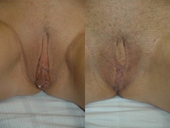 Labiaplasty before 3037820