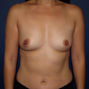35-44 year old woman treated with Breast Augmentation before 3398466