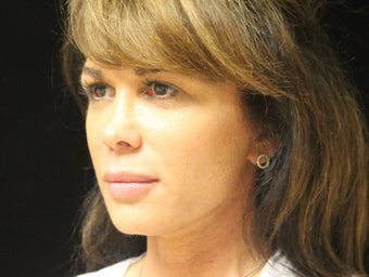 45-54 year old woman treated with Facelift 2509086