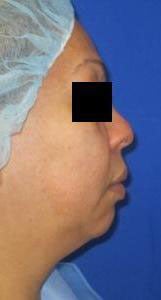 Chin Implant before 3141707
