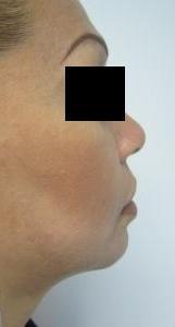 Chin Implant after 3141707