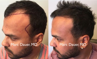 25-34 year old man treated with FUE Hair Transplant after 3377684
