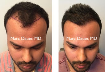 25-34 year old man treated with FUE Hair Transplant before 3377684