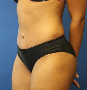 Abdominoplasty (Tummy Tuck) for 34 Year Old Female 1129795
