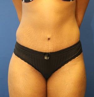 Abdominoplasty (Tummy Tuck) for 34 Year Old Female after 1129795