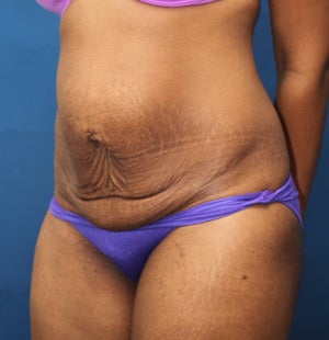 Abdominoplasty (Tummy Tuck) for 34 Year Old Female 1129795