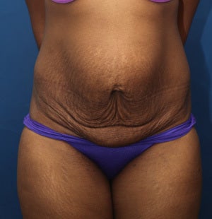 Abdominoplasty (Tummy Tuck) for 34 Year Old Female before 1129795