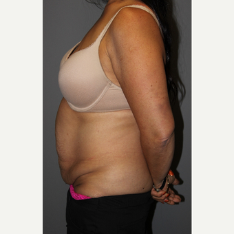 45-54 year old woman treated with Tummy Tuck before 3129281