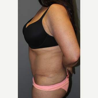 45-54 year old woman treated with Tummy Tuck after 3129281