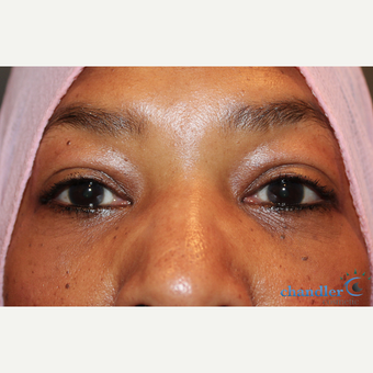 55-64 year old woman treated with Eye Bags Treatment after 3108095