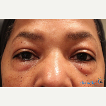 55-64 year old woman treated with Eye Bags Treatment before 3108095