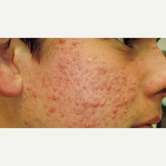 Acne and scar treatments before 1879104