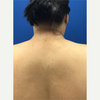 'Buffalo Hump' Liposuction after 3259366