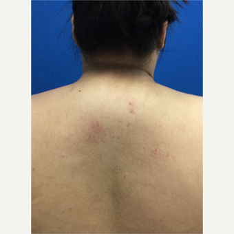 'Buffalo Hump' Liposuction before 3259366
