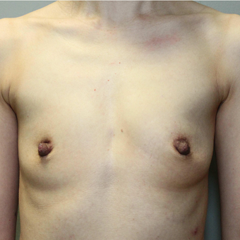 35-44 year old woman treated with Breast Augmentation before 3069760