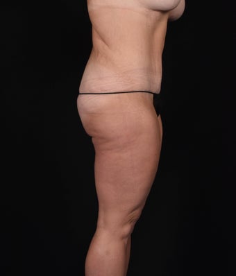 45-54 year old woman treated with SAFELipo 3126404